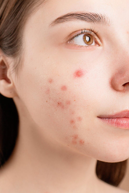5 Ways to Fight Acne